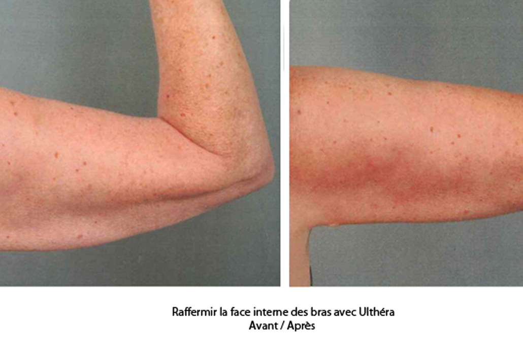 lifter la peau des bras sans chirurgie avec l'Ulthérapy