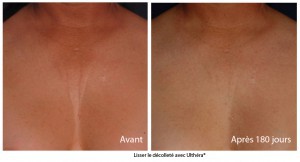 Lifting sans chirurgie du décolleté avec Ultherapy