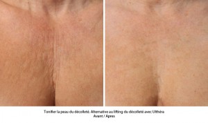 Ultherapy avant apres
