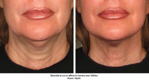 avec ultherapy retendre la peau du cou et du menton sans chirurgie