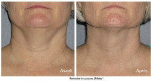 Rajeunir le cou et le menton sans chirurgie centre ulthérapy Paris
