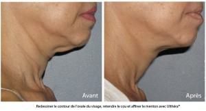 L'ovale du visage redessiné avec le traitement ultherapy