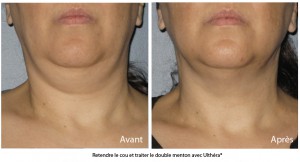 Rajeunir le cou et le menton sans chirurgie avec le traitement Ulthérapy