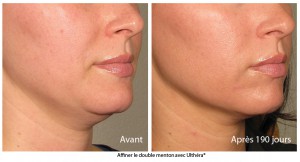 lifting cou et menton sans chirurgie centre Ulthérapy Paris