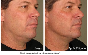 Ultherapy avant apres