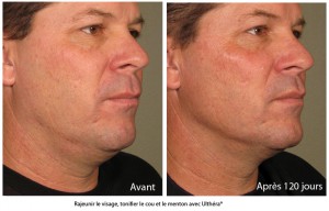 Ultherapy avant apres