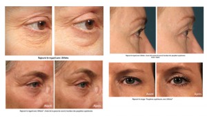 Ultherapy avant apres