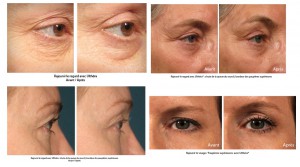 Ultherapy avant apres