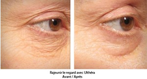 Ultherapy avant apres