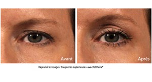 Ultherapy avant apres
