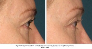 Ultherapy avant apres