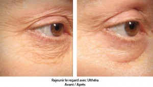 Ultherapy avant apres