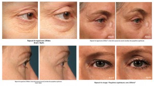 Ultherapy avant apres