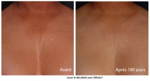 Lifting medical | sans chirurgie avec l'Ulthérapy