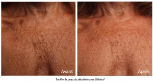 Ultherapy avant apres