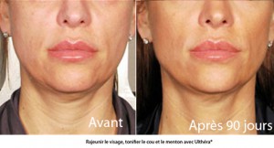 Rajeunir l'ovale du visage sans chirurgie centre ulthérapy Paris