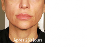 Rajeunir l'ovale du visage sans chirurgie centre ulthérapy Paris