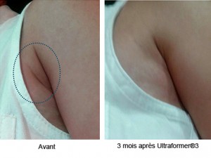Lisser et rentendre la peau des bras sans chirurgie grâce à l'Ulthérapy