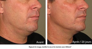 Avec l'ulthérapy, rajeunir le visage sans chirurgie