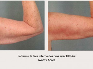 Ultherapy avant apres
