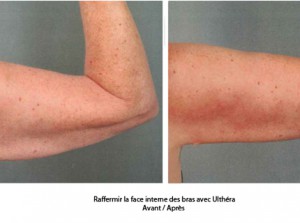 Ultherapy avant apres