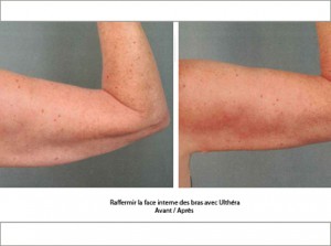 Ultherapy avant apres