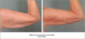 Ultherapy avant apres
