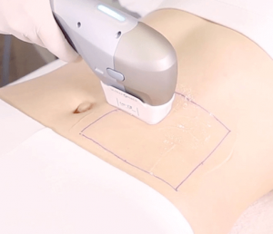 utherapy ventre