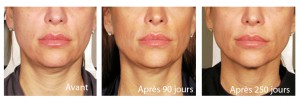Ultherapy avant apres