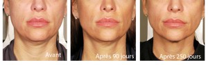 Ultherapy avant apres