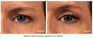 Ultherapy avant apres