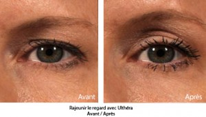 lifting et rajeunissement du visage sans chirurgie ultherapy