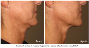 lifting ovale visage sans chirurgie traitement ultherapy