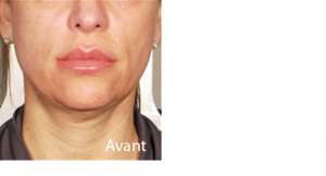 Ultherapy avant apres