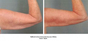 Ultherapy avant apres