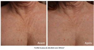 Ultherapy avant apres