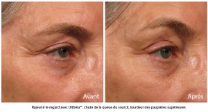Ultherapy avant apres