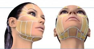 Ultherapy zones