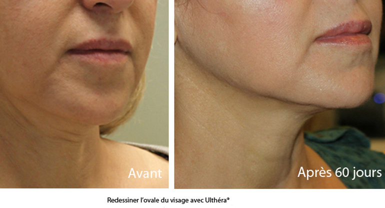 ovale visage redessiner sans chirurgie traitement ultherapy