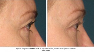 lifting du visage sans chirurgie avec ultherapy paris