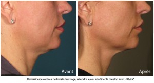 Ultherapy avant apres