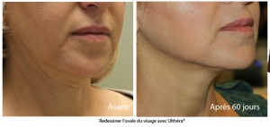 Ultherapy avant apres