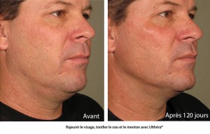 Ultherapy avant apres
