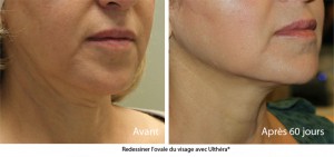 Ultherapy avant apres