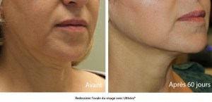 Ultherapy avant apres
