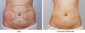 Relâchement cutané | Retendre la peau sans chirurgie avec l'Ulthérapy
