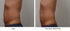 Lifting médical sans chirurgie dans le Centre Ultherapy à Paris