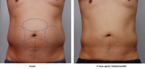 Relâchement cutané | Retendre la peau sans chirurgie avec l'Ulthérapy