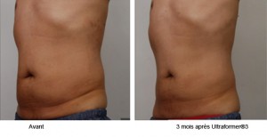 traitement ulthérapy lifting médical sans chirurgie peau ventre