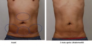 lifting médical sans chirurgie ventre ultherapy